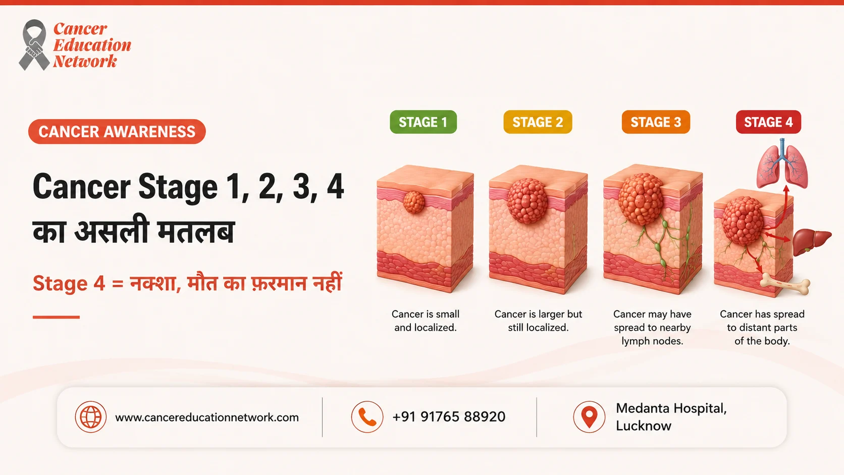 Understand the real meaning of Cancer Stages 1, 2, 3, and 4 with simple medical illustrations. Stage 4 means cancer has spread (metastasis), not an immediate death sentence.