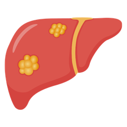 Liver Cancer
