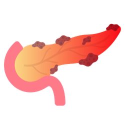 Pancreatic Cancer