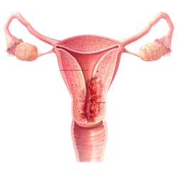 Endometrial Cancer