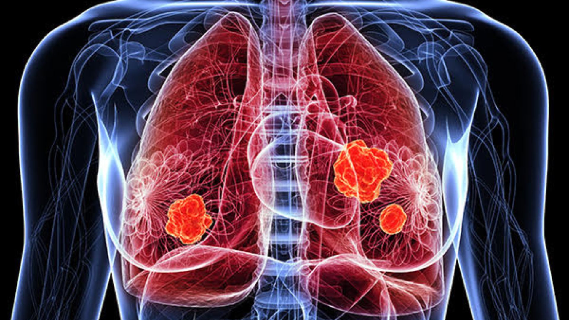 Lung Cancer: The Silent Killer