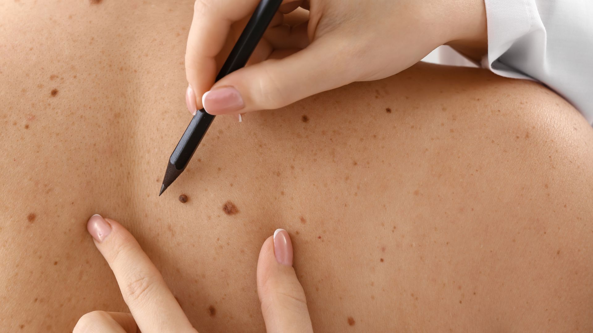 Skin Cancer Warning: These Spots Could Be Deadly