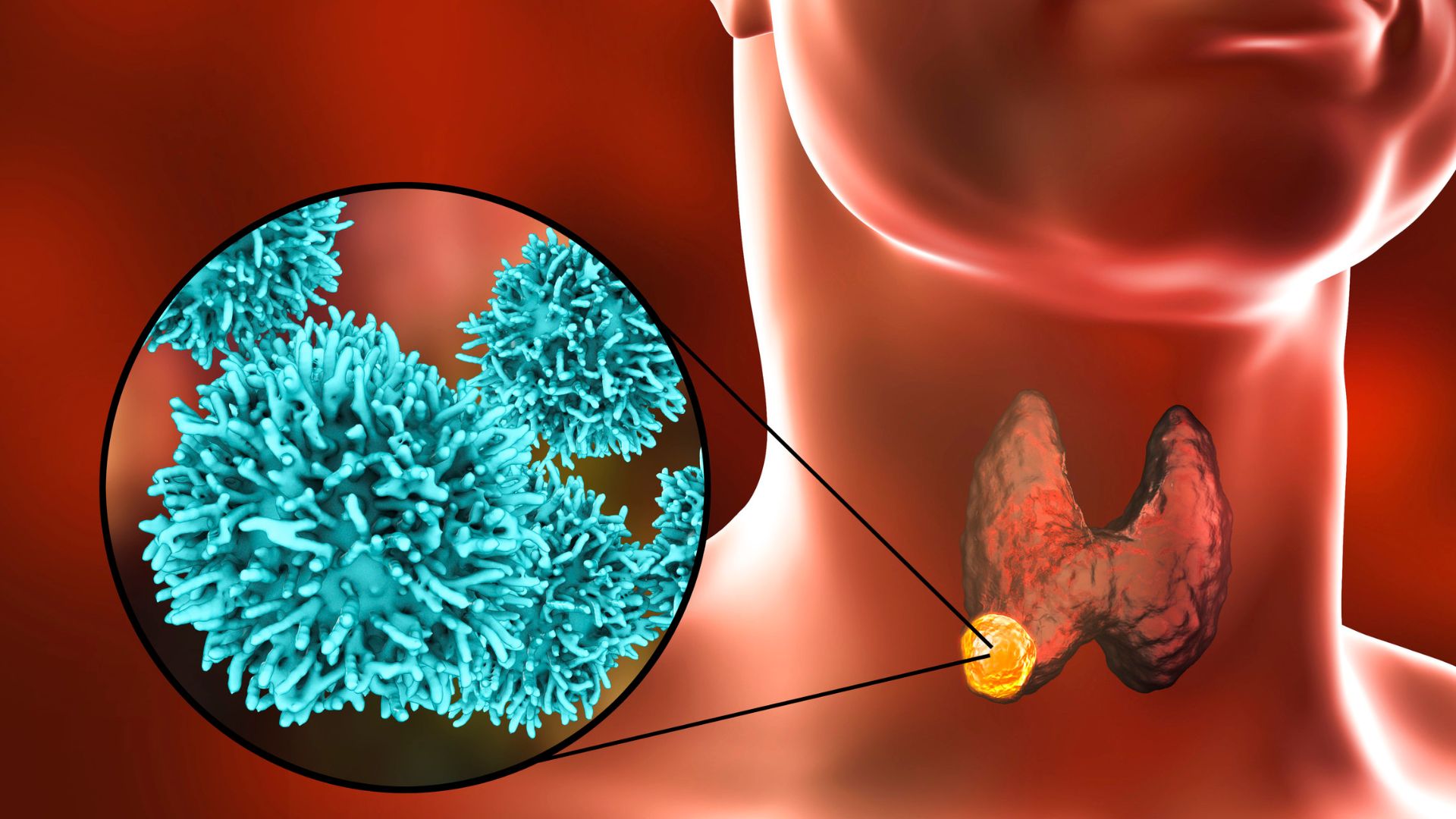 Thyroid Cancer Alert: Neck Lumps You Should Never Ignore