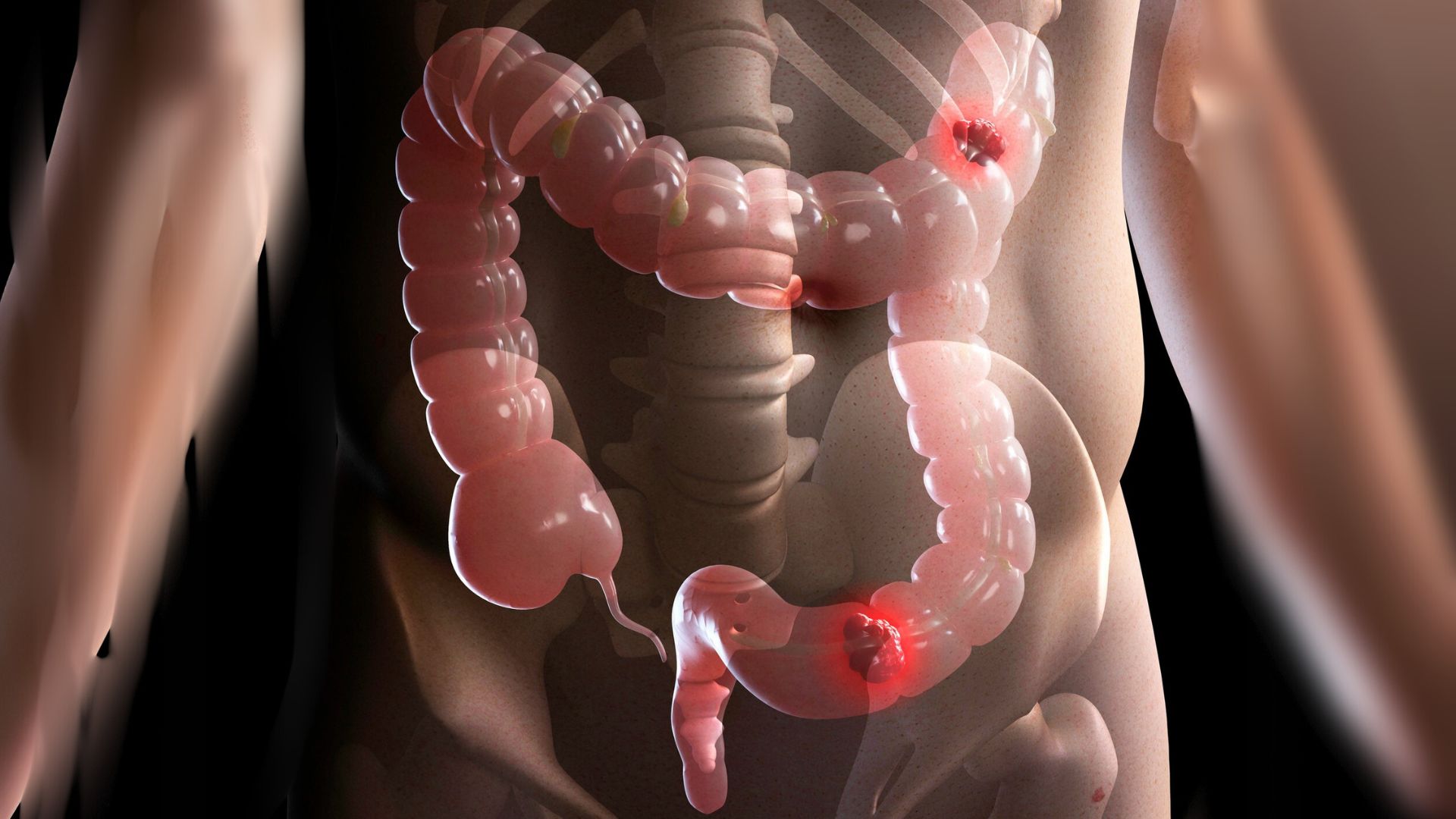 Hidden Danger: Know the Signs of Colorectal Cancer